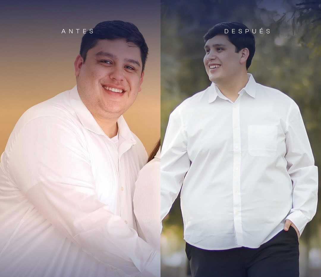 Before and After Image for Gastric Bypass Surgery in Mexicali, Mexico