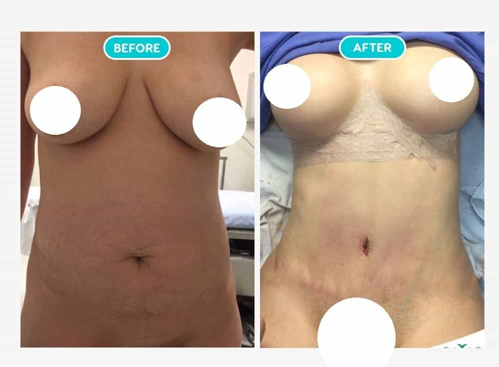 Before After Image for Breast Augmentation in Mexicali, Mexico