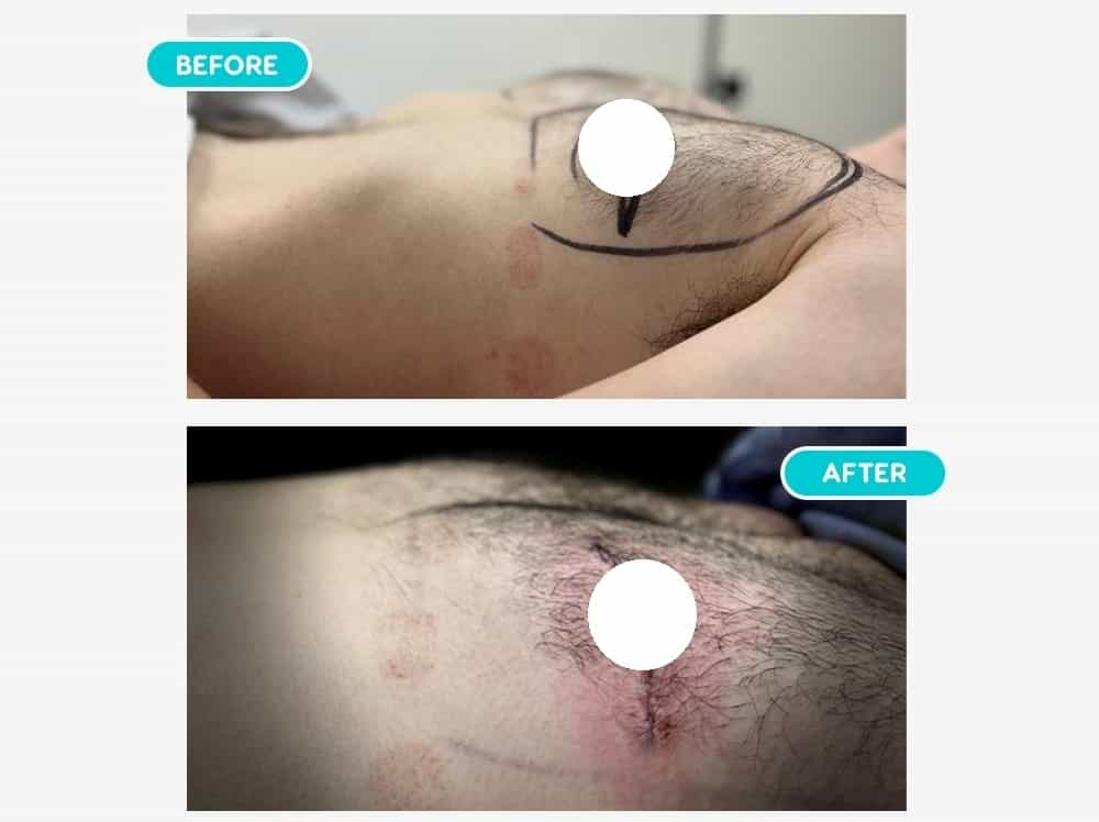 Before After Image for Gynecomastia in Mexicali, Mexico