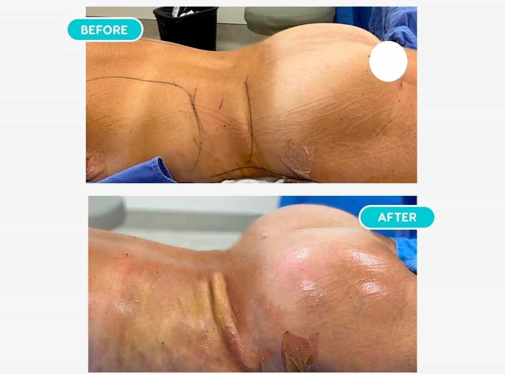 Before After Image for Liposuction in Mexicali, Mexico