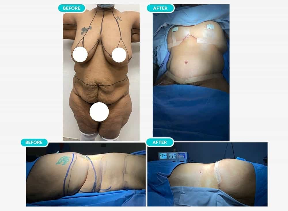 Before After Image for Tummy Tuck in Mexicali, Mexico