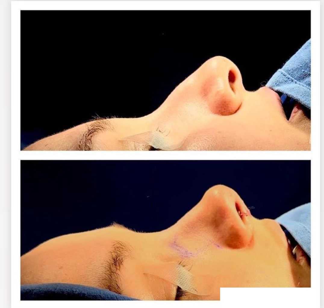 Before and After Images for Rhinoplasty in Tijuana Mexico