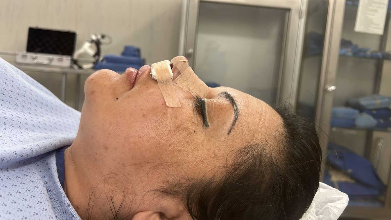 Before and After Images for Nose Surgery in Tijuana Mexico