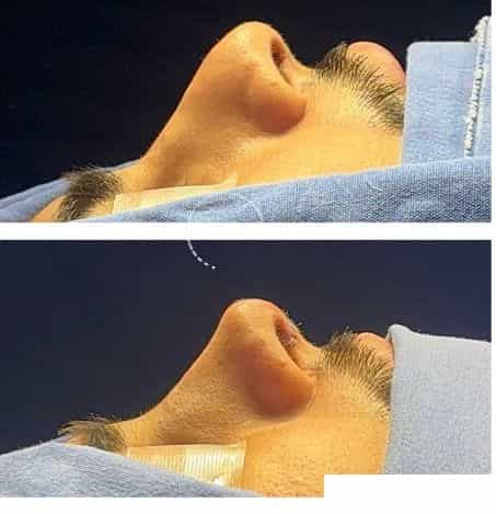 Before and After Images for Rhinoplasty in Tijuana