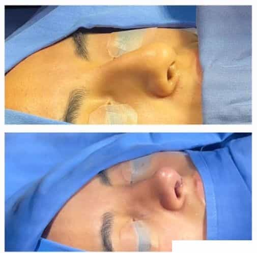 Before and After Images for Rhinoplasty Tijuana Mexico