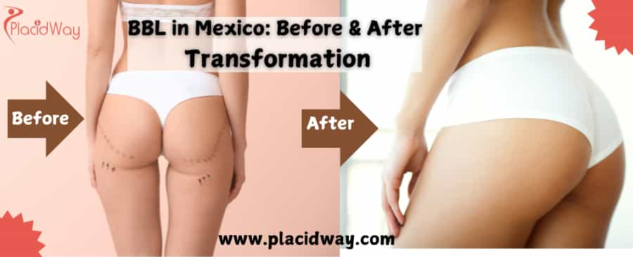 BBL in Mexico Before & After Transformation Guide