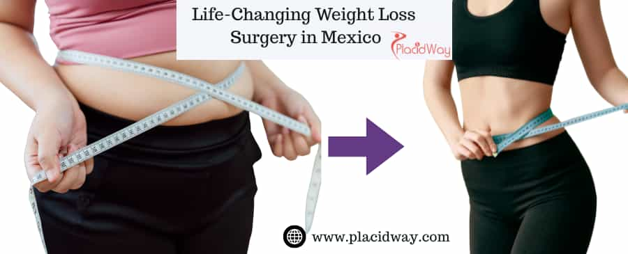 Success Story of Patients Get Amazing Life-Changing after Having Weight Loss Surgery in Mexico