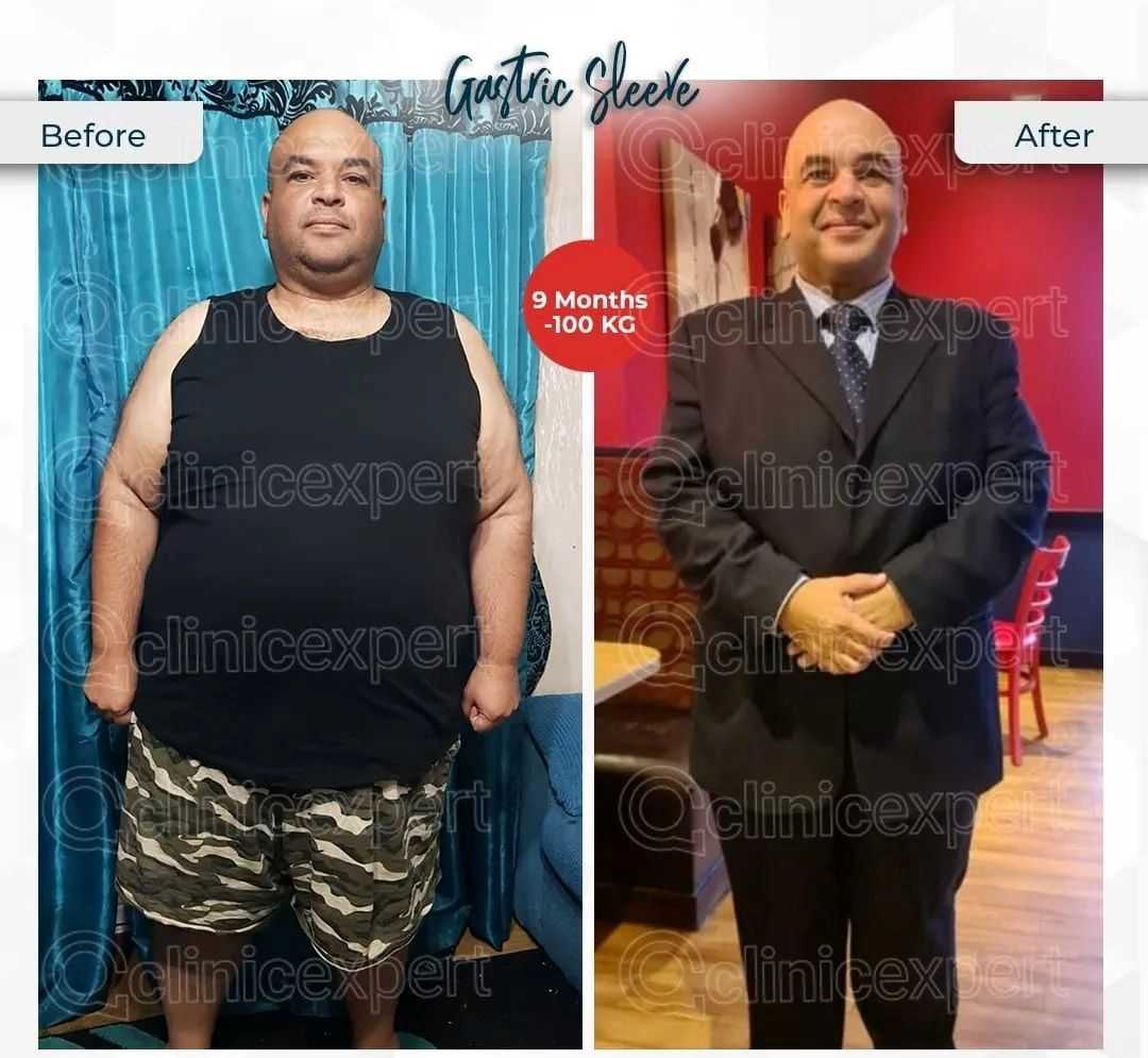 Before and After Image for Bariatric Surgery in Istanbul Turkey