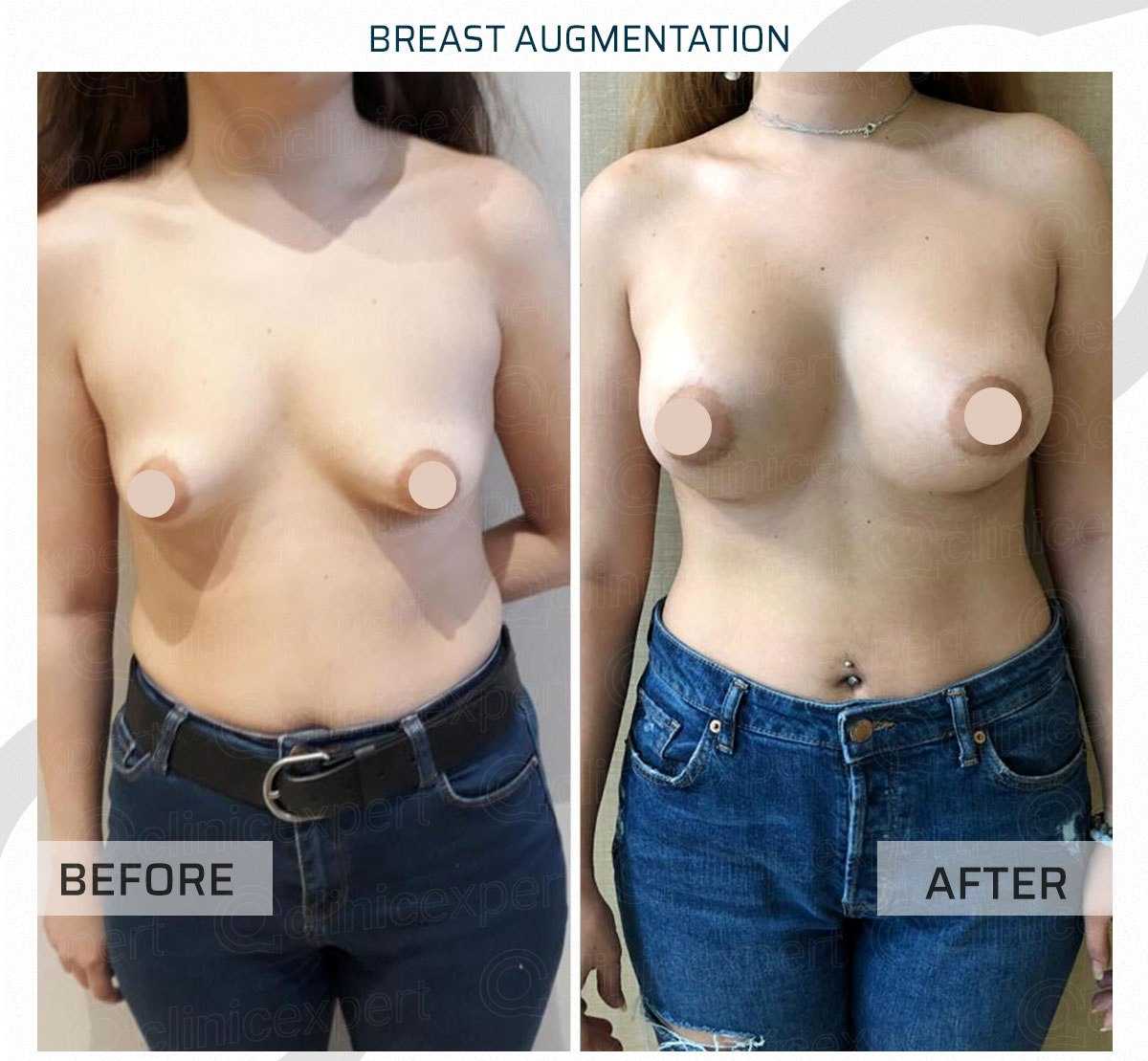 Before and After Image for Breast Augmentation in Istanbul Turkey