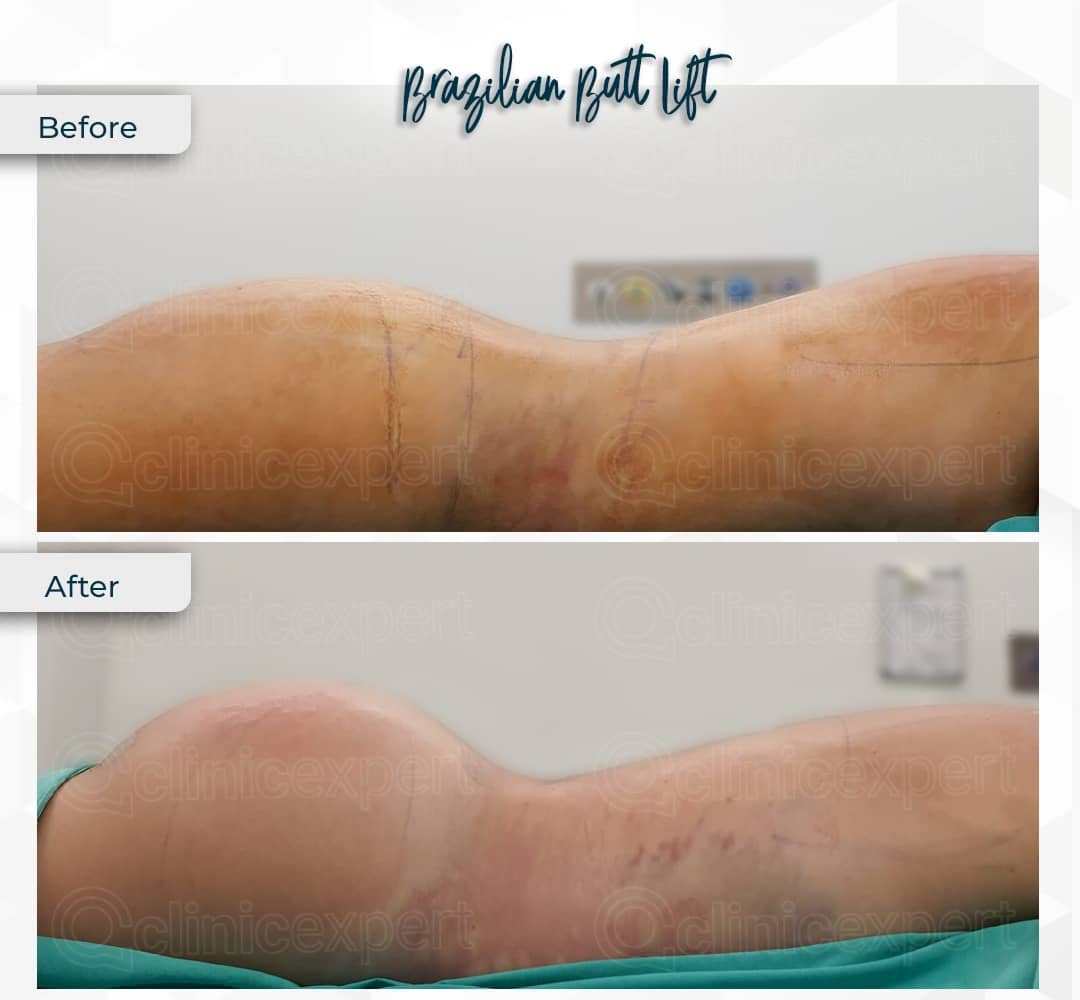 Before and After Image for Buttock Augmentation in Istanbul Turkey