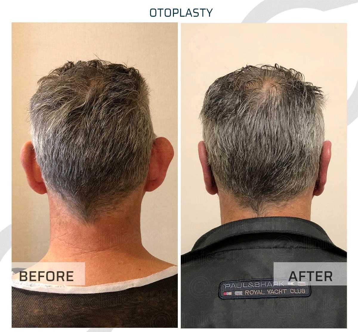 Before and After Image for Hair Transplant in Istanbul Turkey