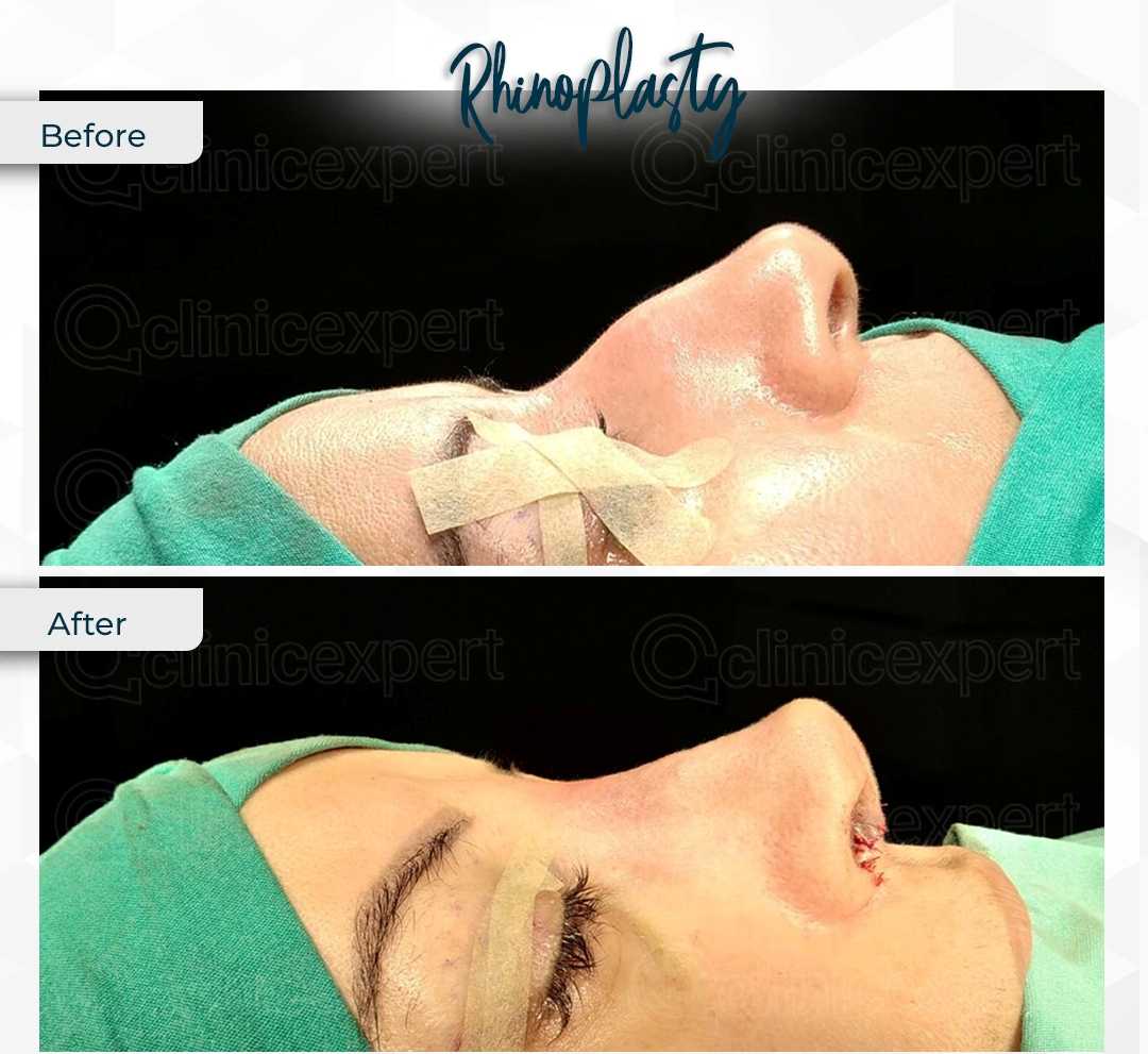 Before and After Image for Rhinoplasty in Istanbul Turkey