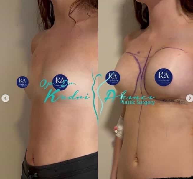 Before and After Breast Implants in Antalya, Turkey