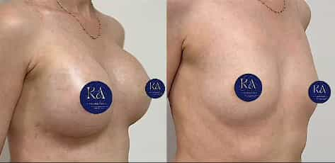 Breast Implants in Antalya, Turkey Before and After Image