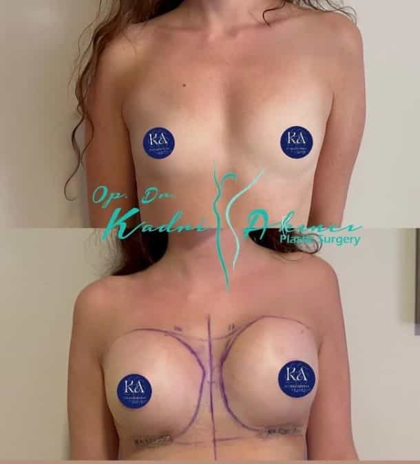 Before and After Breast Implants in Antalya