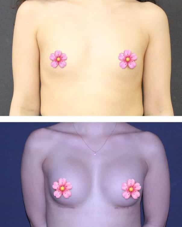 Before and After Breast Implants in Turkey