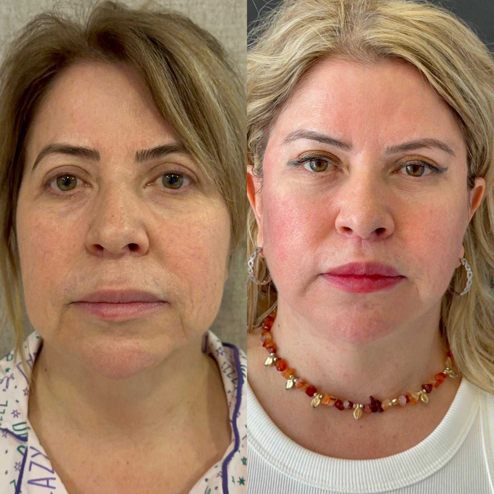 Imagen de antes y después de un lifting facial en Antalya, Turquía