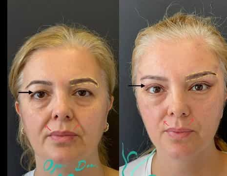 Transformación de lifting facial en Antalya, Turquía