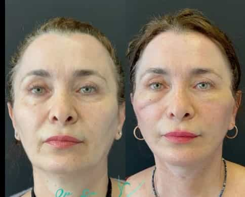 Lifting facial en Antalya antes y después