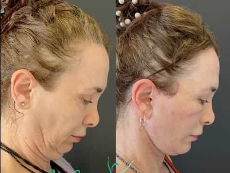 Resultados del lifting facial en Antalya