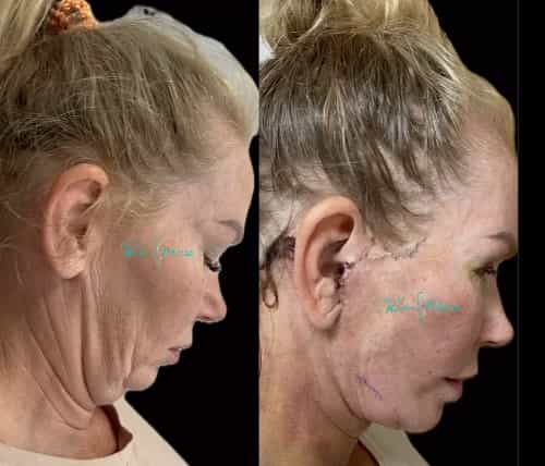 Resultados de la cirugía de lifting facial en Antalya