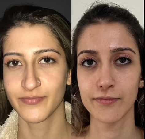 Nose Reshaping Results in Antalya