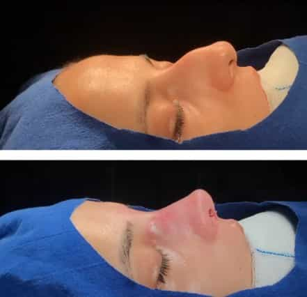 Antalya Rhinoplasty Surgery Outcomes