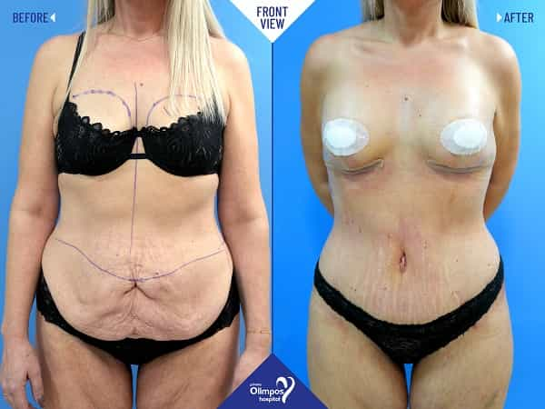 Before and After Image for Tummy Tuck in Antalya Turkey