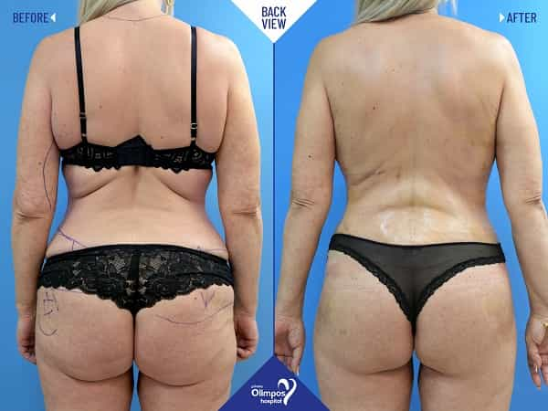 Tummy Tuck Transformation Antalya, Turkey