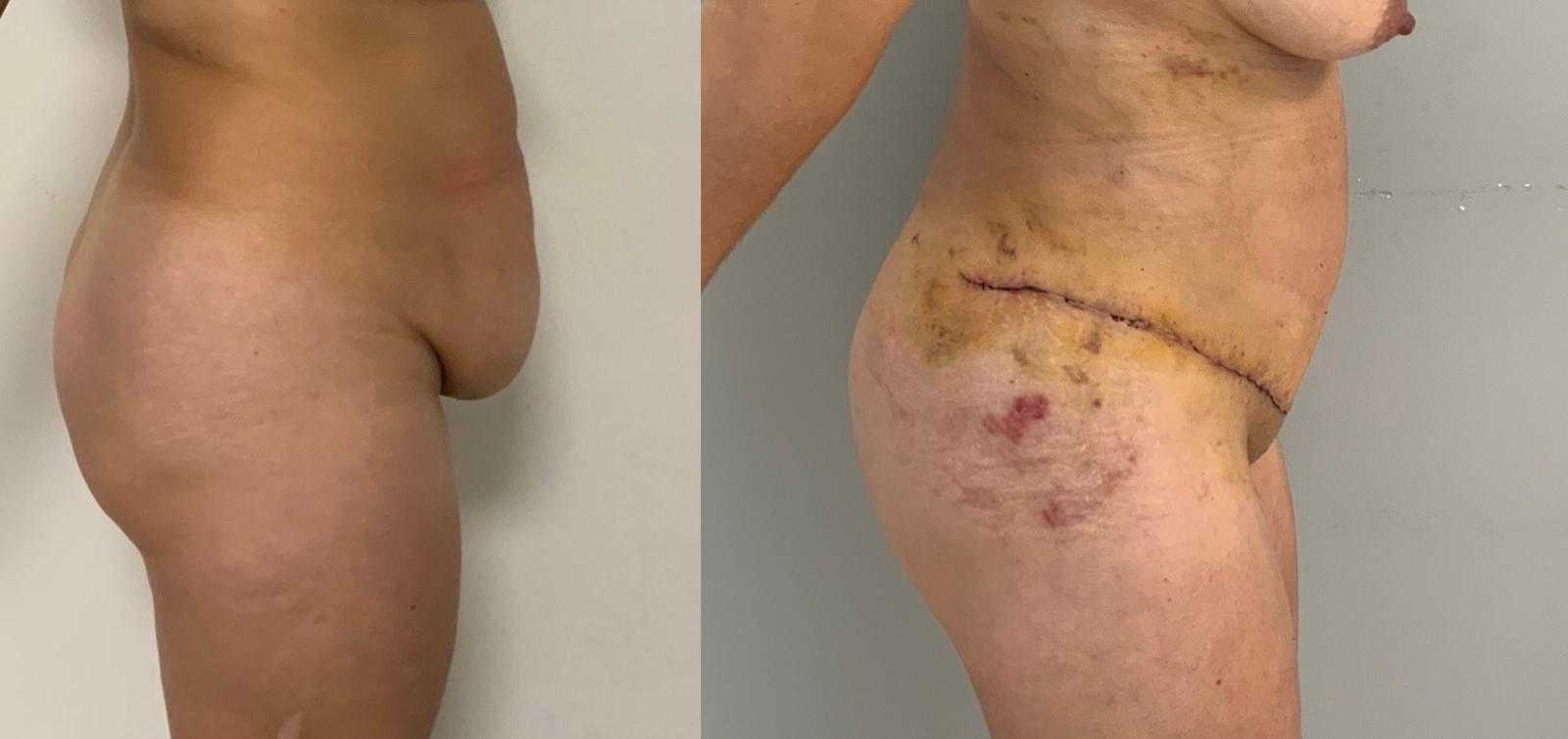 Abdominoplasty Results in Antalya