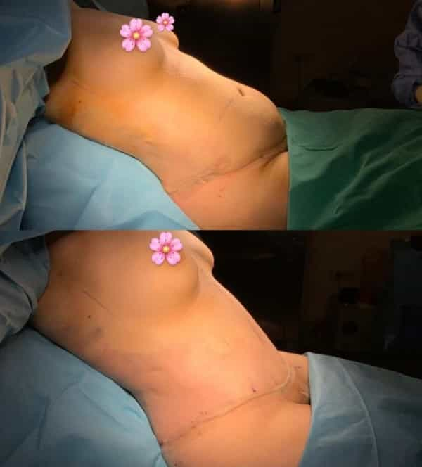 Antalya Tummy Tuck Surgery Outcomes