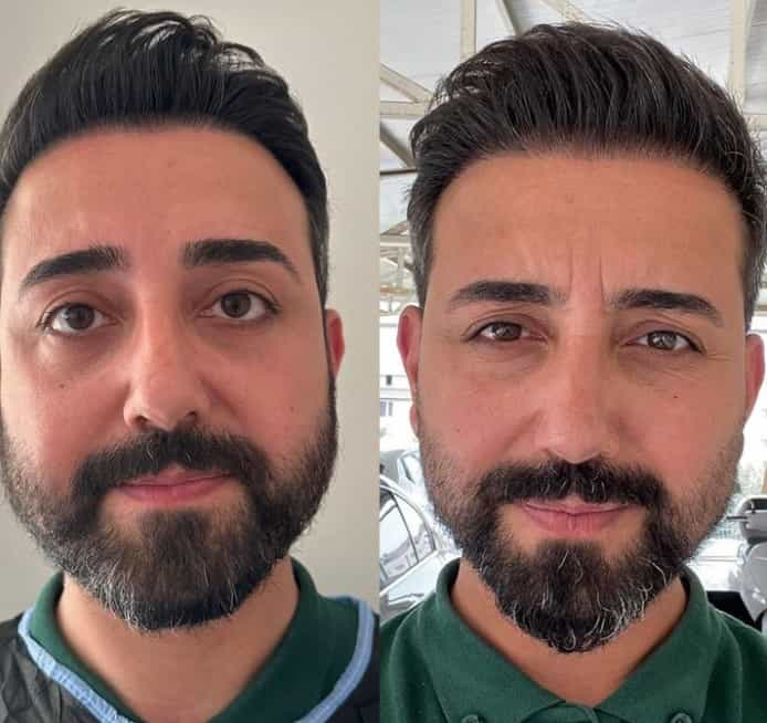 Before and After Image for Bichectomy in Antalya, Turkey