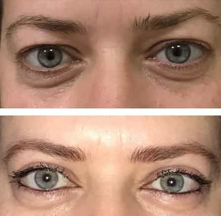 Before and After Image for Eyelid Surgery in Antalya, Turkey