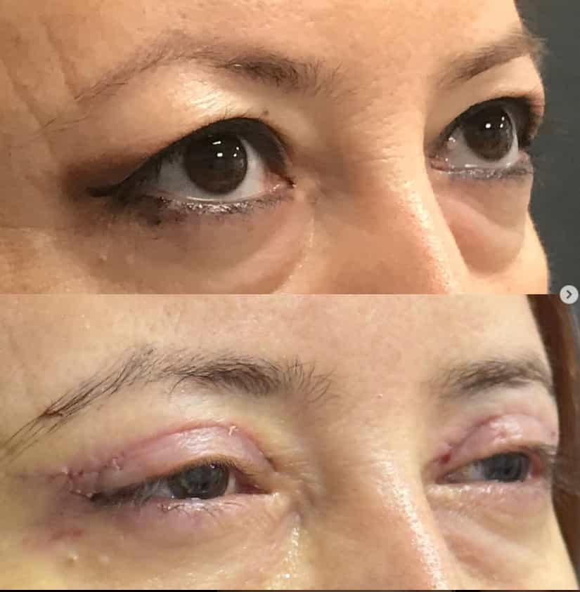 Eyelid Lift Outcome in Antalya, Turkey