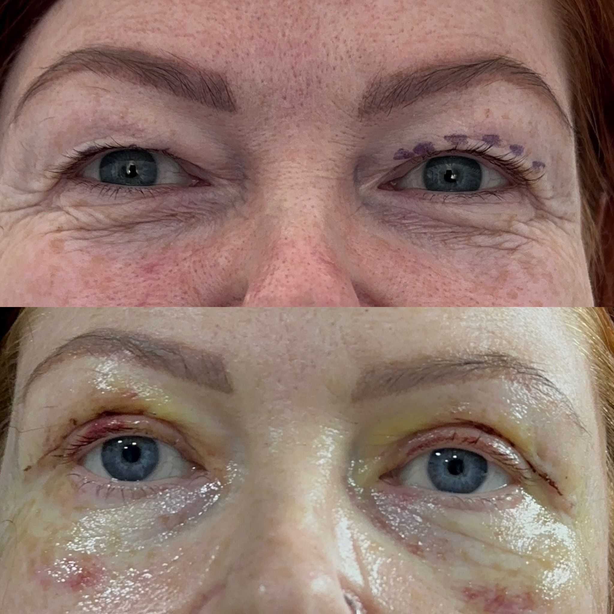 Eyelid Surgery Makeover in Antalya, Turkey