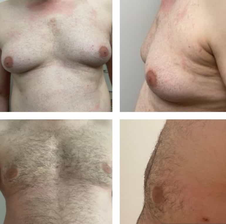 Before and After Image for Gynecomastia in Antalya, Turkey