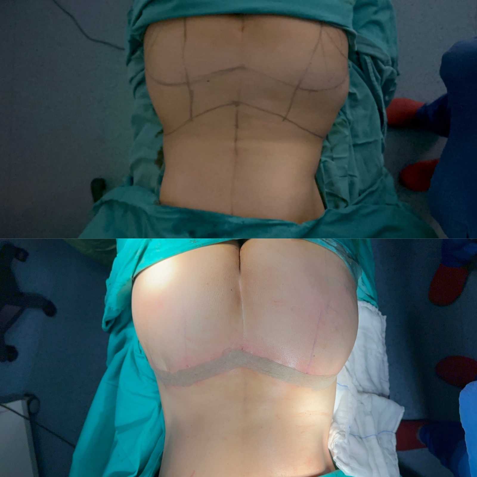 Before and After Image for Lower Back Lift in Antalya, Turkey