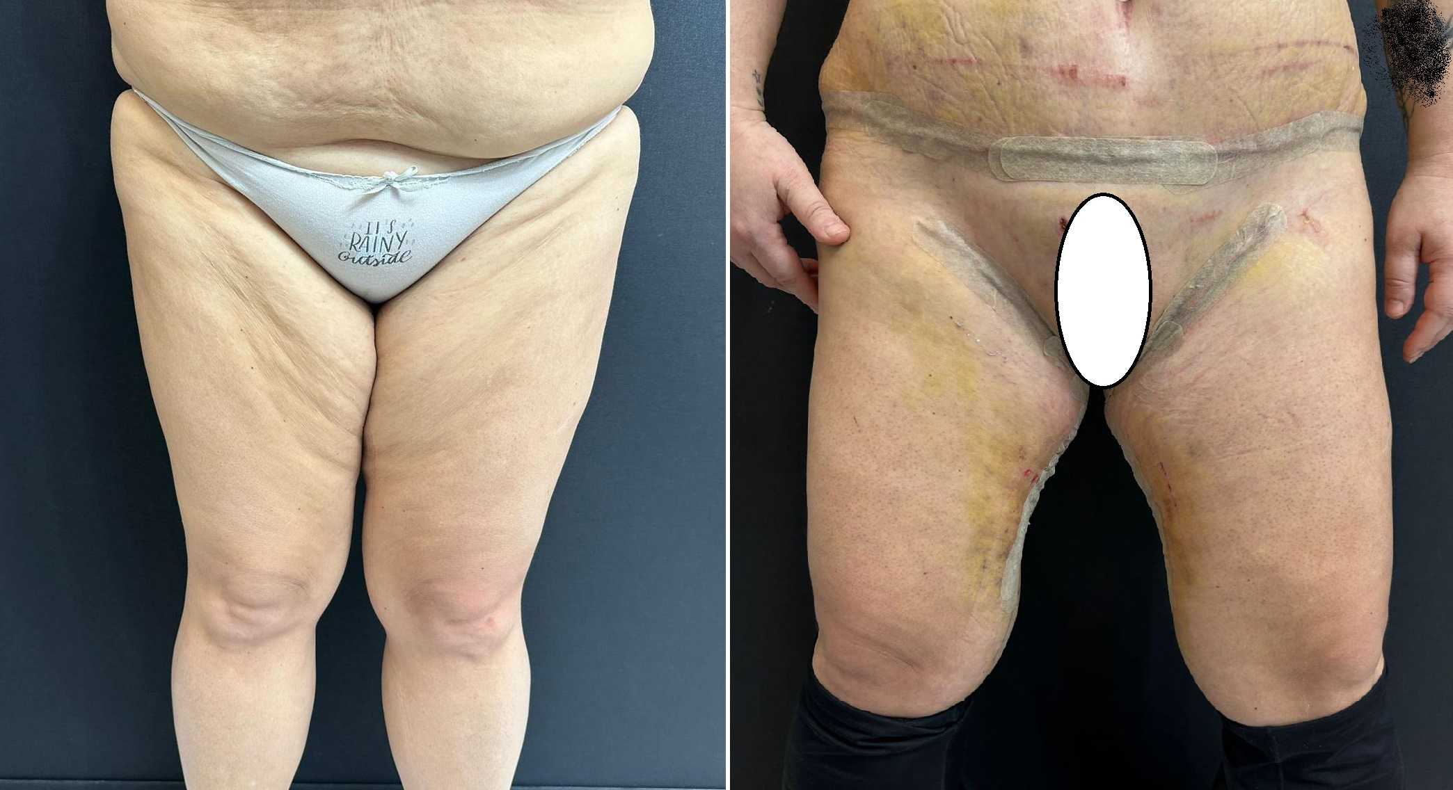 Thigh Lift in Antalya, Turkey Before and After Image