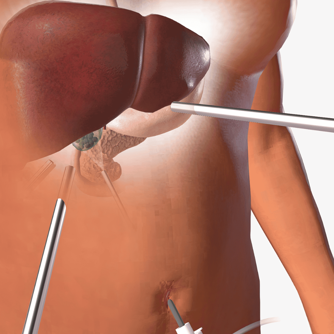 Gallbladder Removal Surgery in Mexico