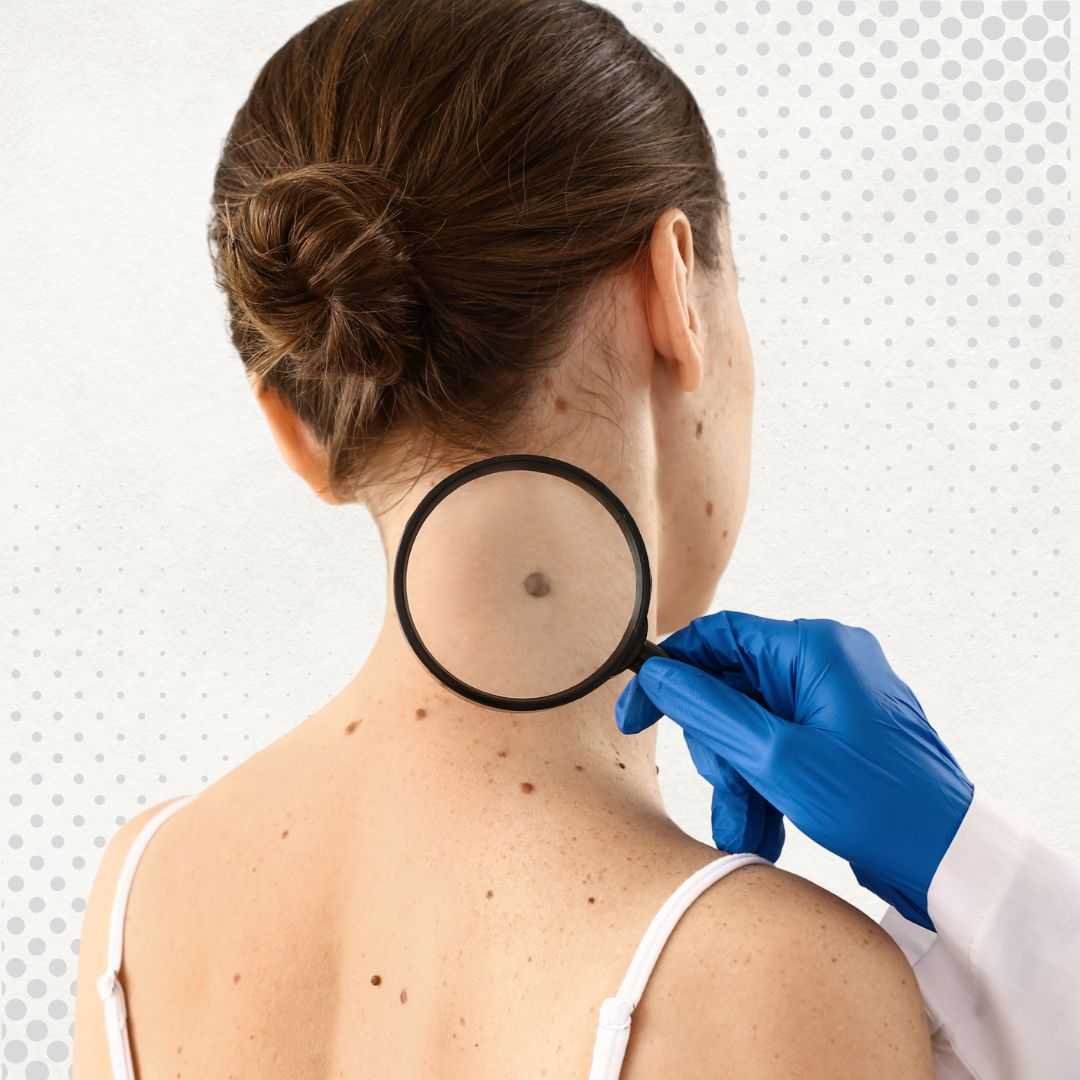 Immunotherapy China: TILs Therapy for Melanoma