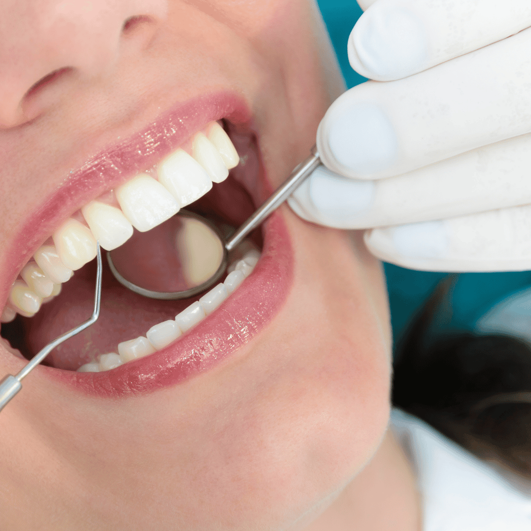 High Quality Dental Fillings Package in Los Algodones Mexico