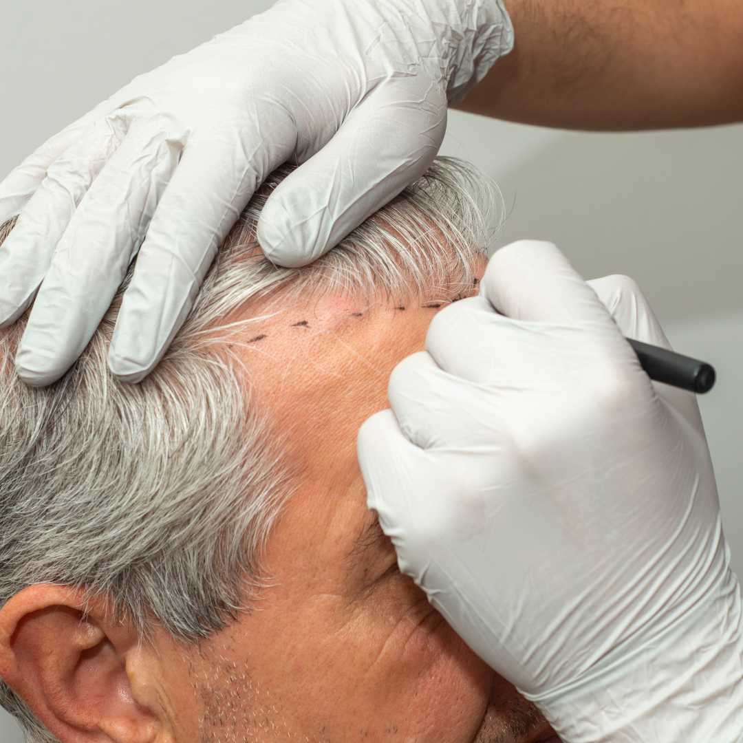 Best FUE Hair Transplant Package in Istanbul Turkey