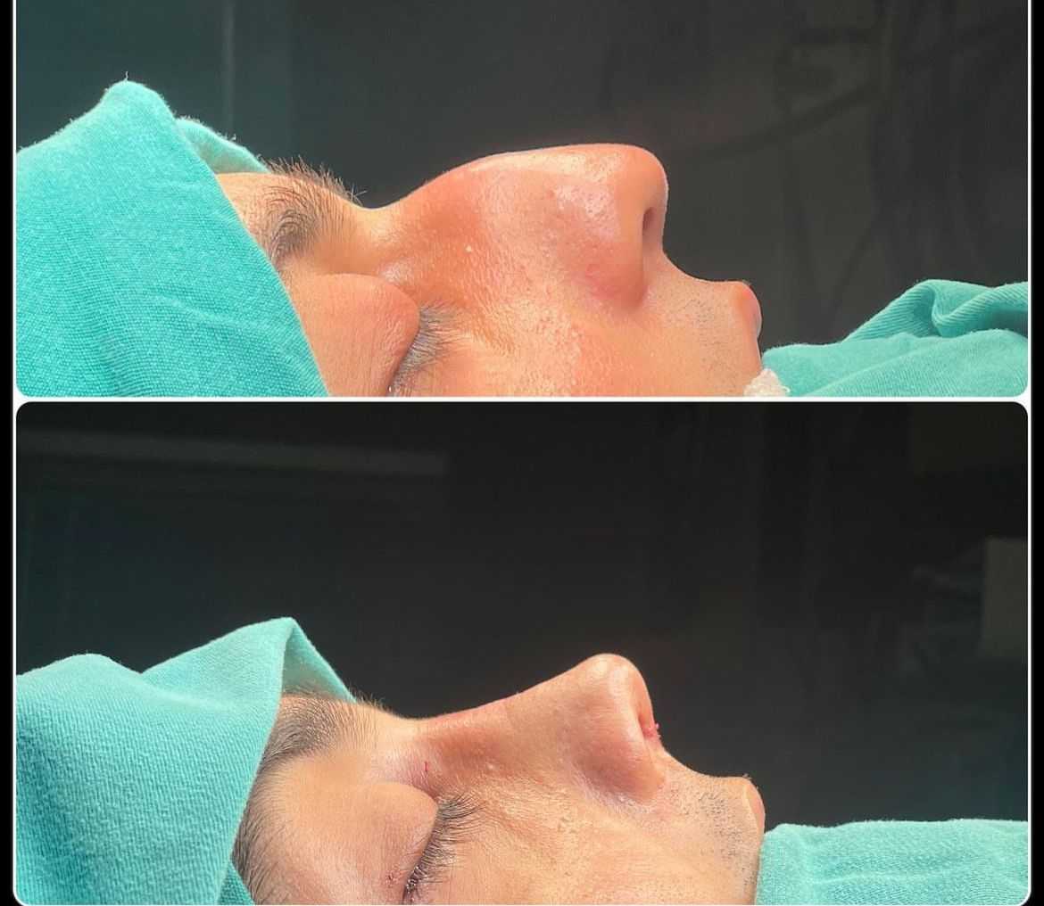 Rhinoplasty Package in Baku, Azerbaijan with Liv Bona Hospital