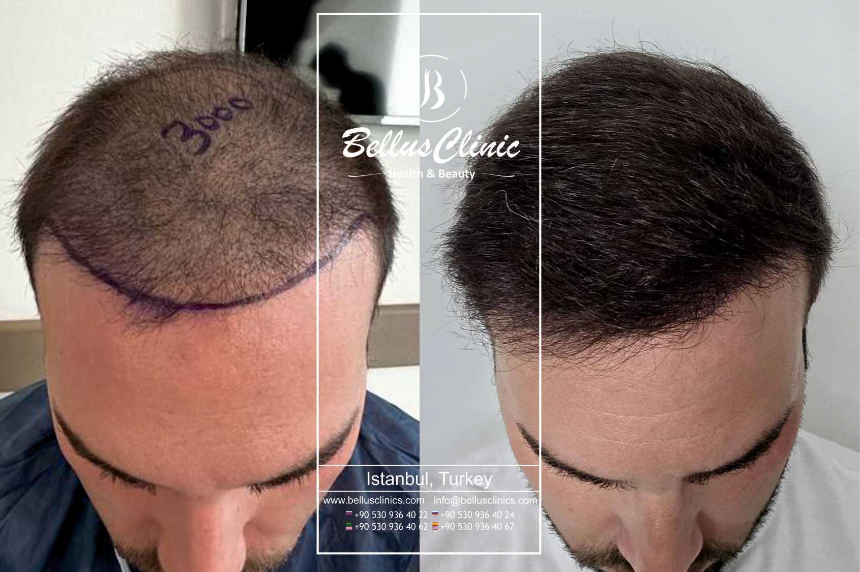 DHI Hair Transplant package from Bellus Clinic