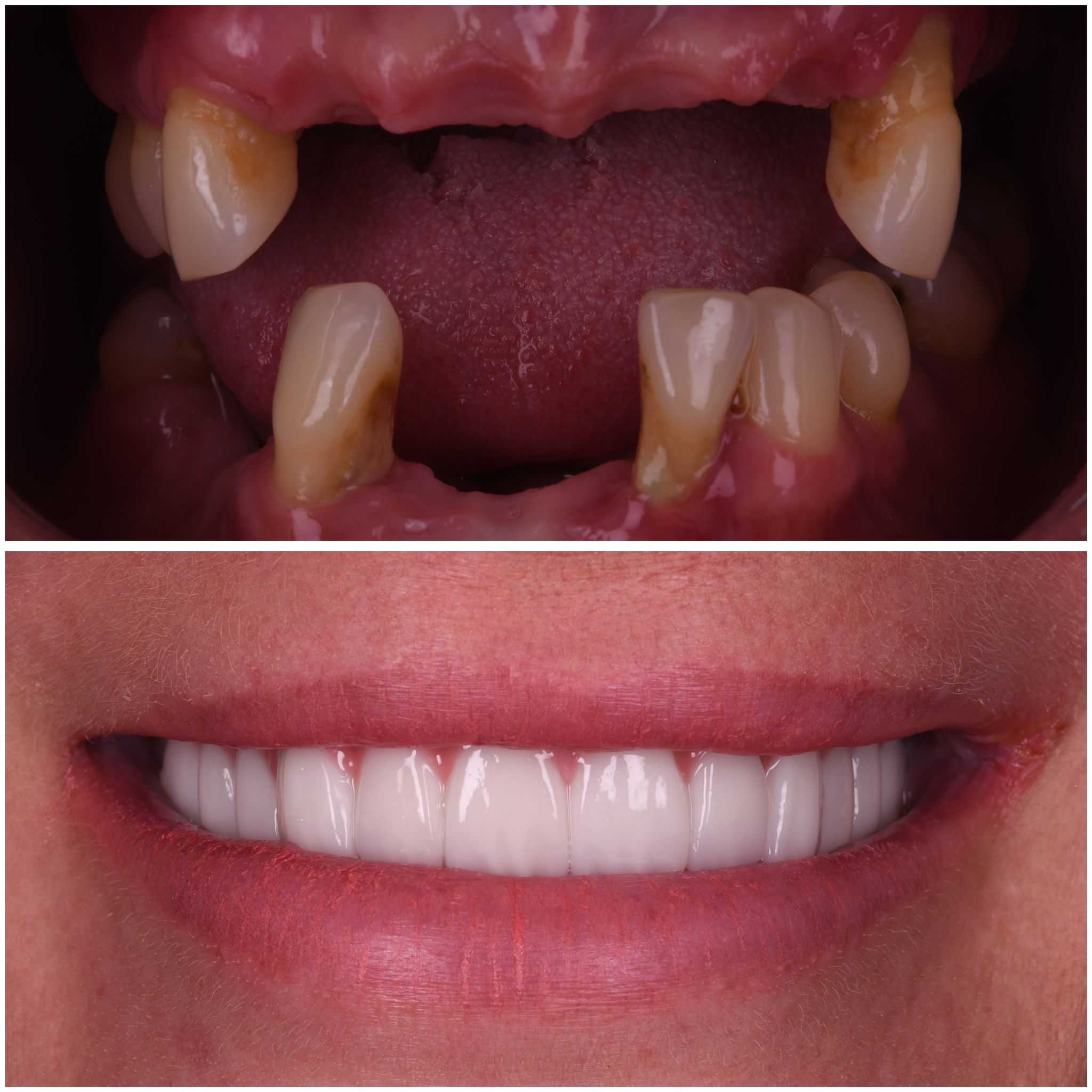  Neodent Straumann All on 4  Dental Implants with Titanium Hybrid Prosthesis Package at Clinic Prime Istanbul, Istanbul, Turkey