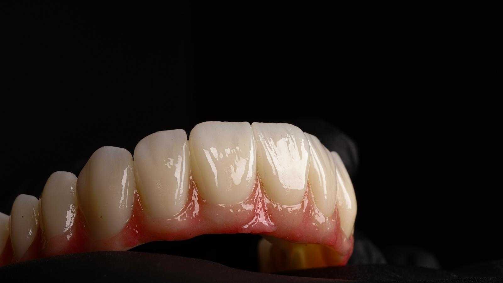 Ivoclar Zirconium Crowns