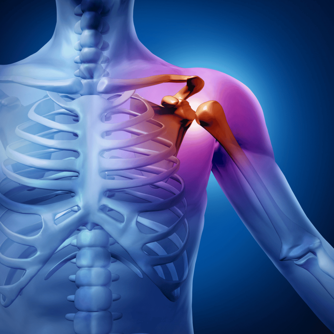 Why Mexico is Emerging as a Leading Destination for Rotator Cuff Surgeries