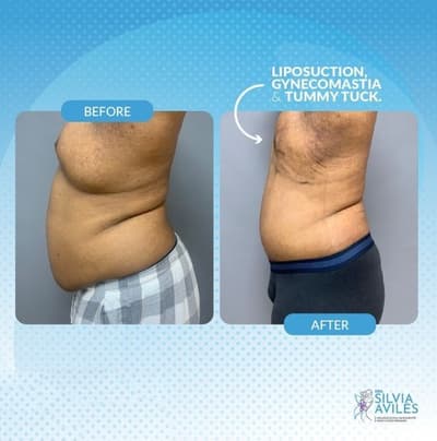 before and after tummy tuck in dominican republic