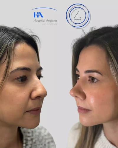 rhinoplasty in mexico