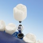 Single Dental Implant Package in Antalya, Turkey thumbnail